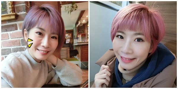 【醫美】淚溝掰掰 蘋果肌澎澎。玻尿酸填補 讓媽媽素顏也有好氣色。立悅皮膚科診所。南京三民捷運站 - 第76張圖 【醫美】淚溝掰掰 蘋果肌澎澎。玻尿酸填補 讓媽媽素顏也有好氣色。立悅皮膚科診所。南京三民捷運站