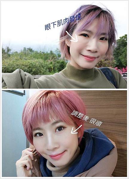 【醫美】淚溝掰掰 蘋果肌澎澎。玻尿酸填補 讓媽媽素顏也有好氣色。立悅皮膚科診所。南京三民捷運站 - 第75張圖 【醫美】淚溝掰掰 蘋果肌澎澎。玻尿酸填補 讓媽媽素顏也有好氣色。立悅皮膚科診所。南京三民捷運站